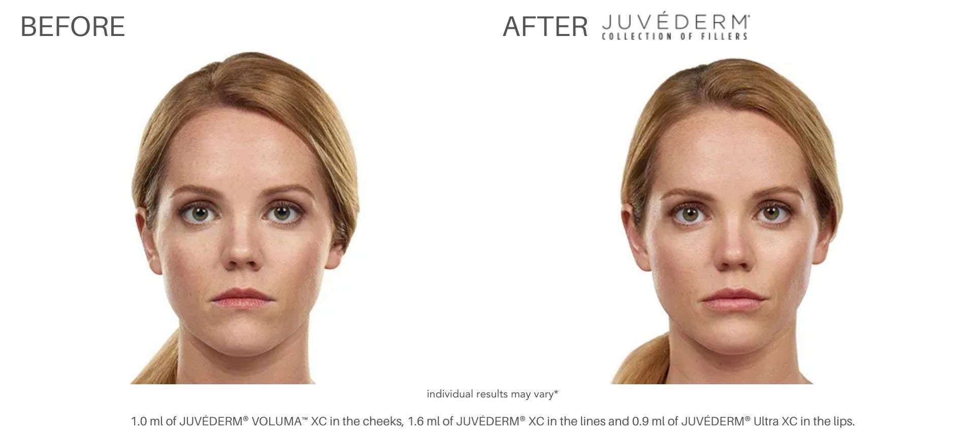 Juvéderm fillers before and after Laser + Skin Institute Medical in Chatham, NJ