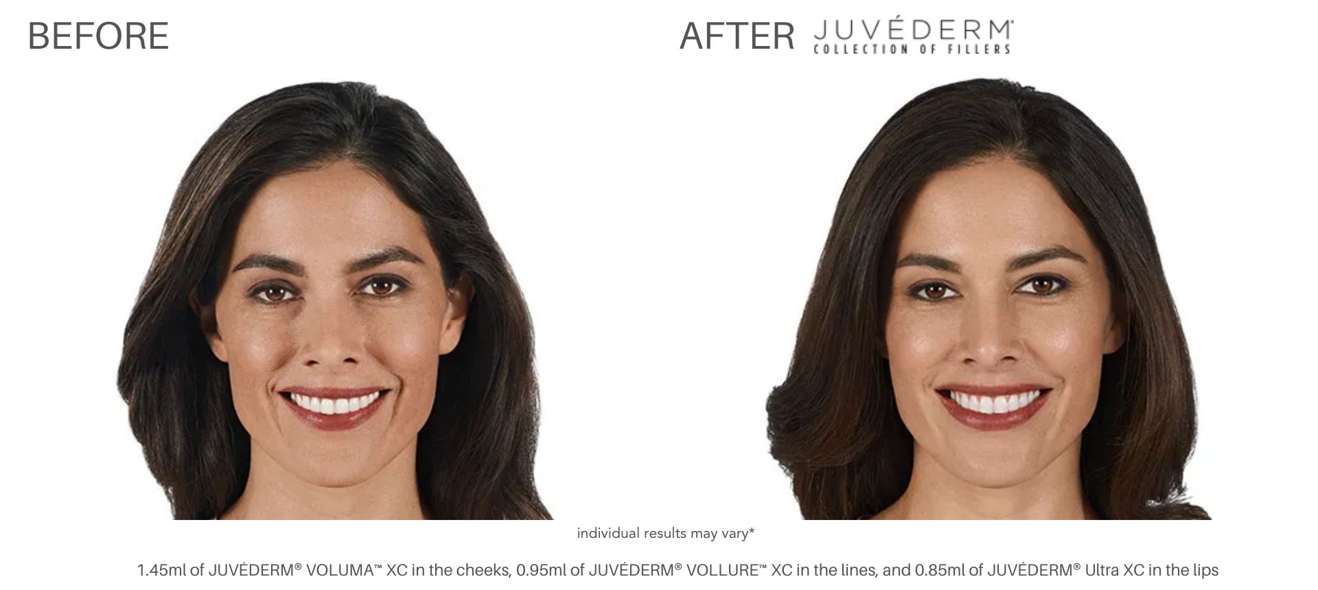 Juvéderm before and after pictures Laser + Skin Institute