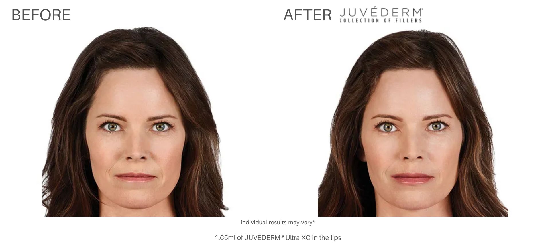 Juvéderm real patients results Laser + Skin Institute in Chatham, NJ