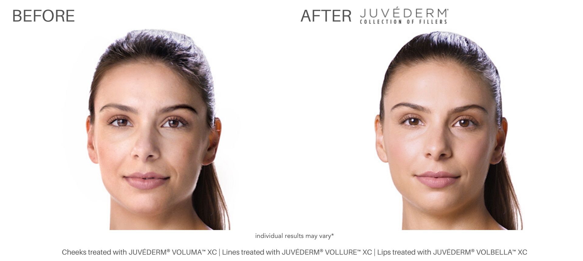 Woman's Juvéderm facial fillers before and after results at Laser + Skin Institute in Chatham, NJ.