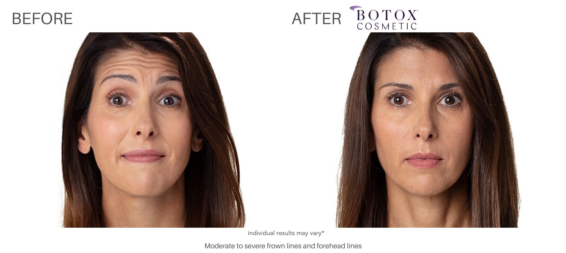 botox cosmetics before and after in Laser + Skin Institute