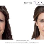 BOTOX BEFORE AND AFTER