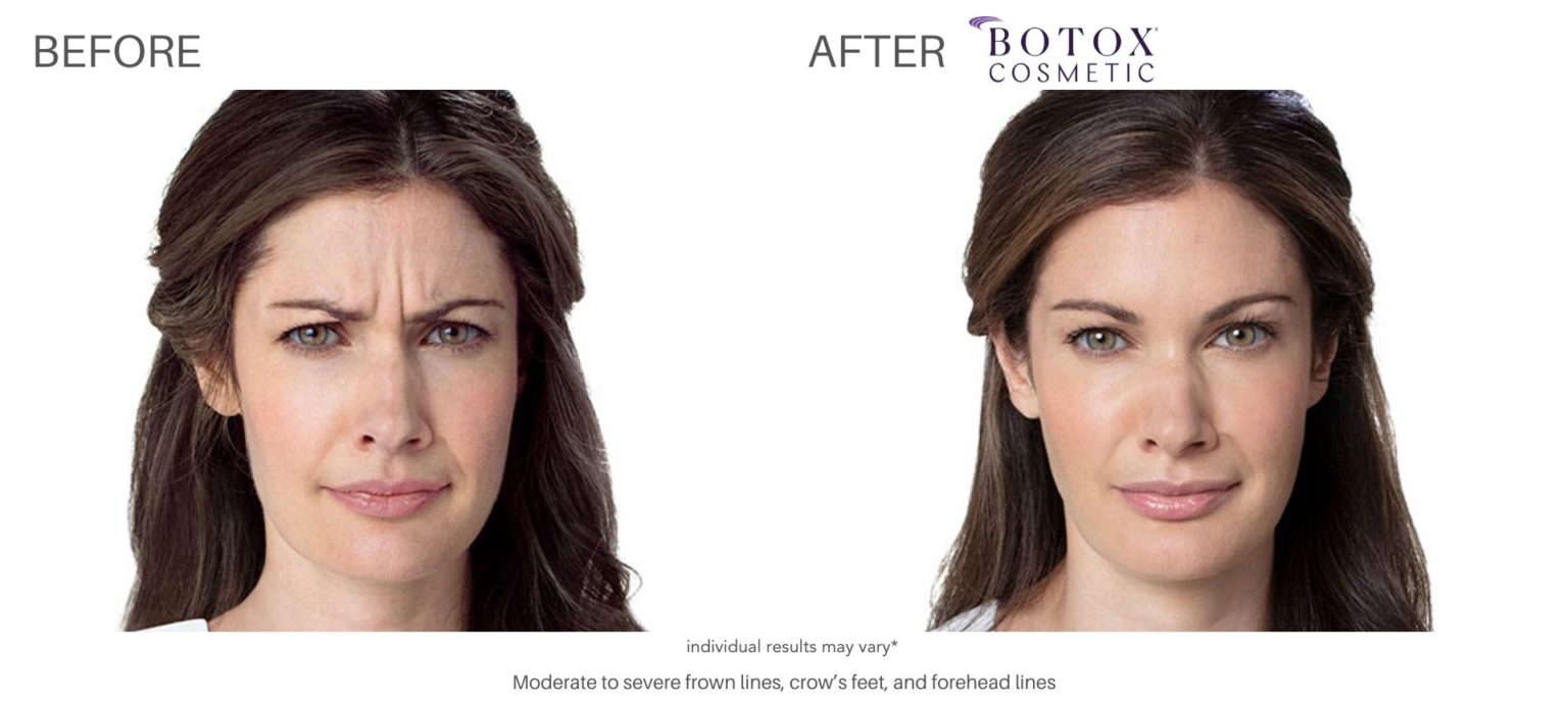 Lip Flip Botox Injections Improve the Upper Lip's Appearance