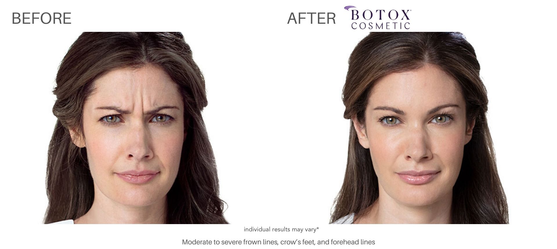 BOTOX BEFORE AND AFTER