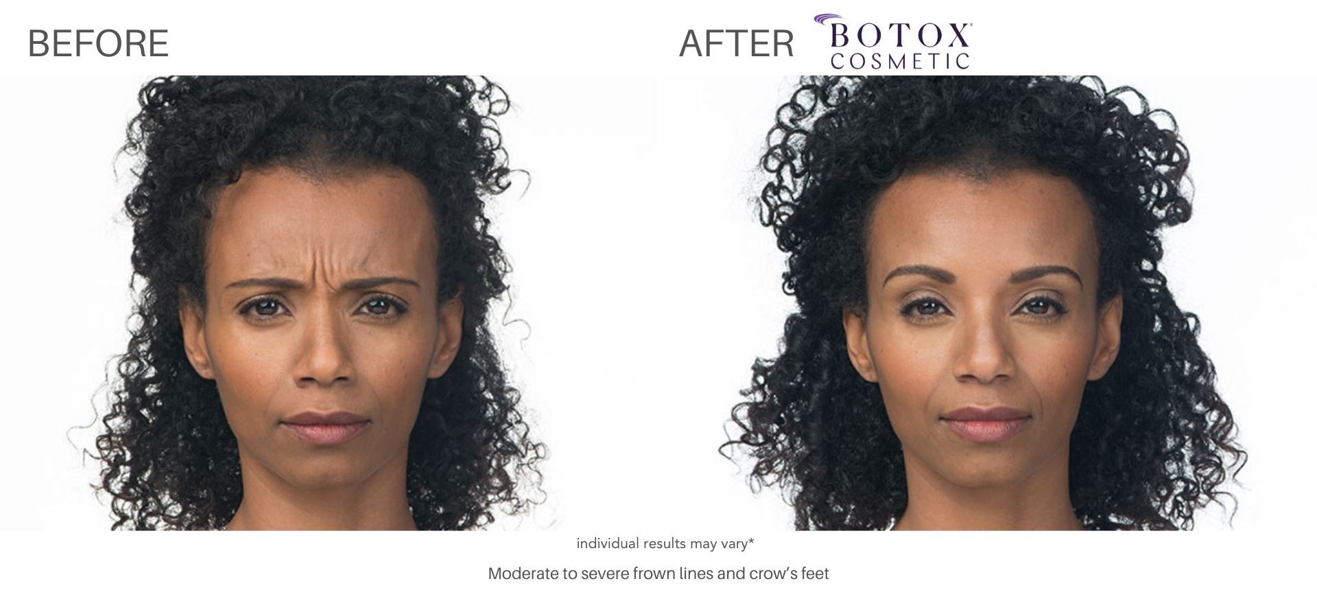 Botox before and after crow’s feet treatment