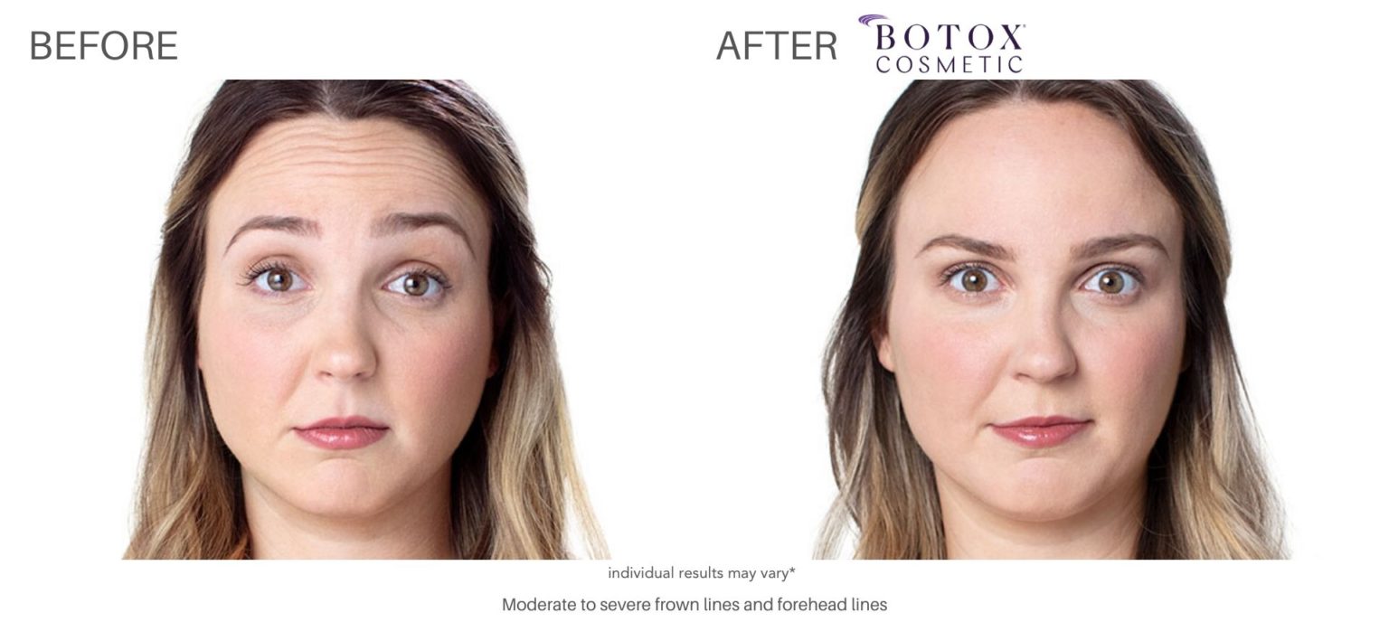 Botox Cosmetic at Laser + Skin Institute Chatam, New Jersey