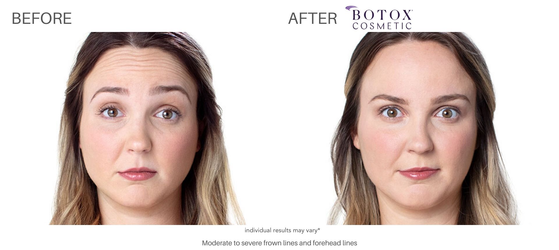 Woman's botox before and after forehead wrinkles treatment.