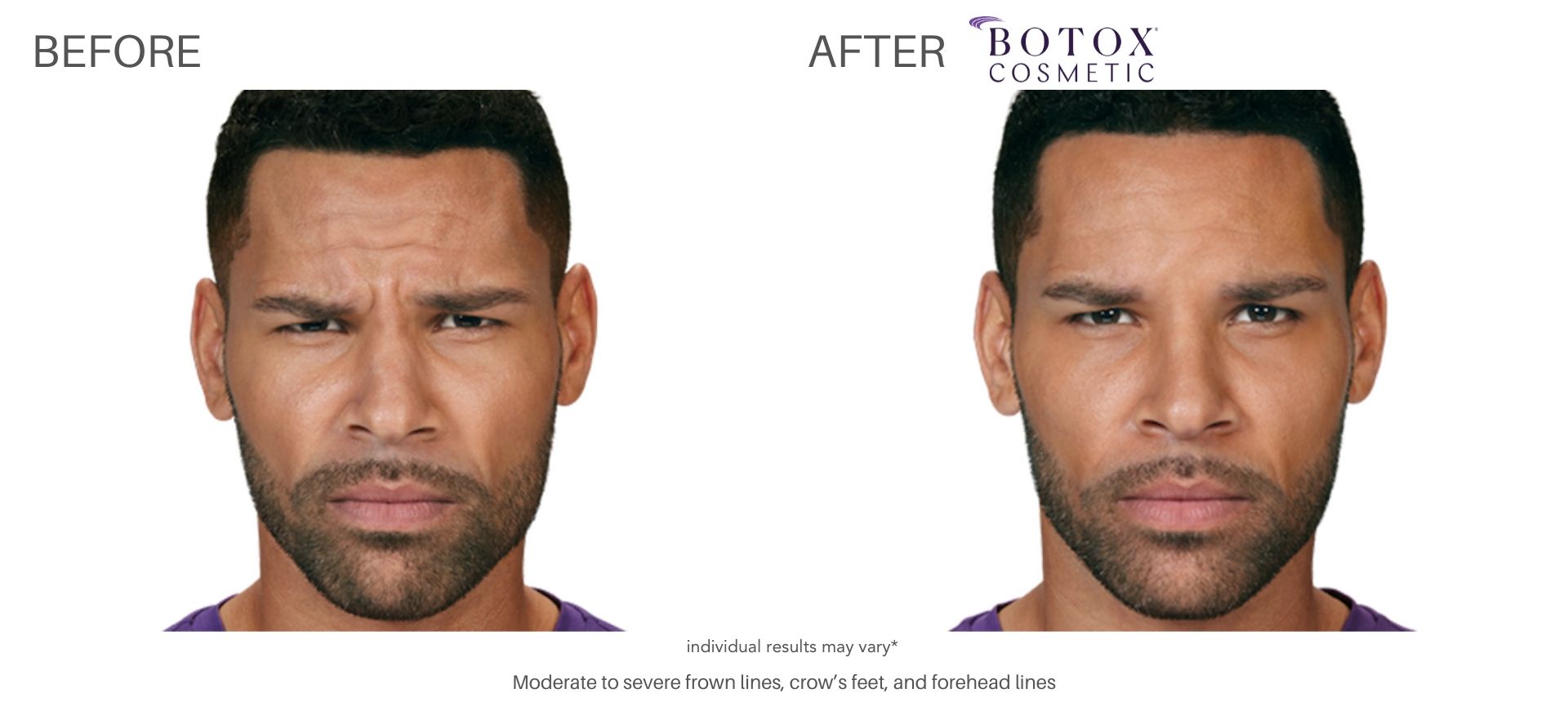 Botox before and after pictures in Chatham, NJ