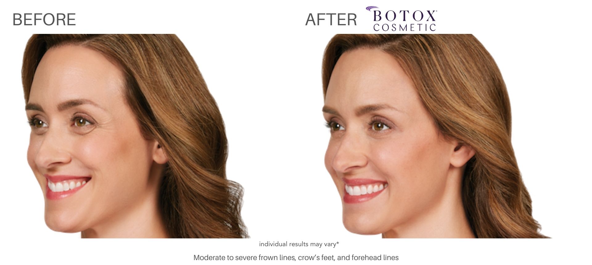 Woman's botox before and after images transformation of crows feet wrinkles.