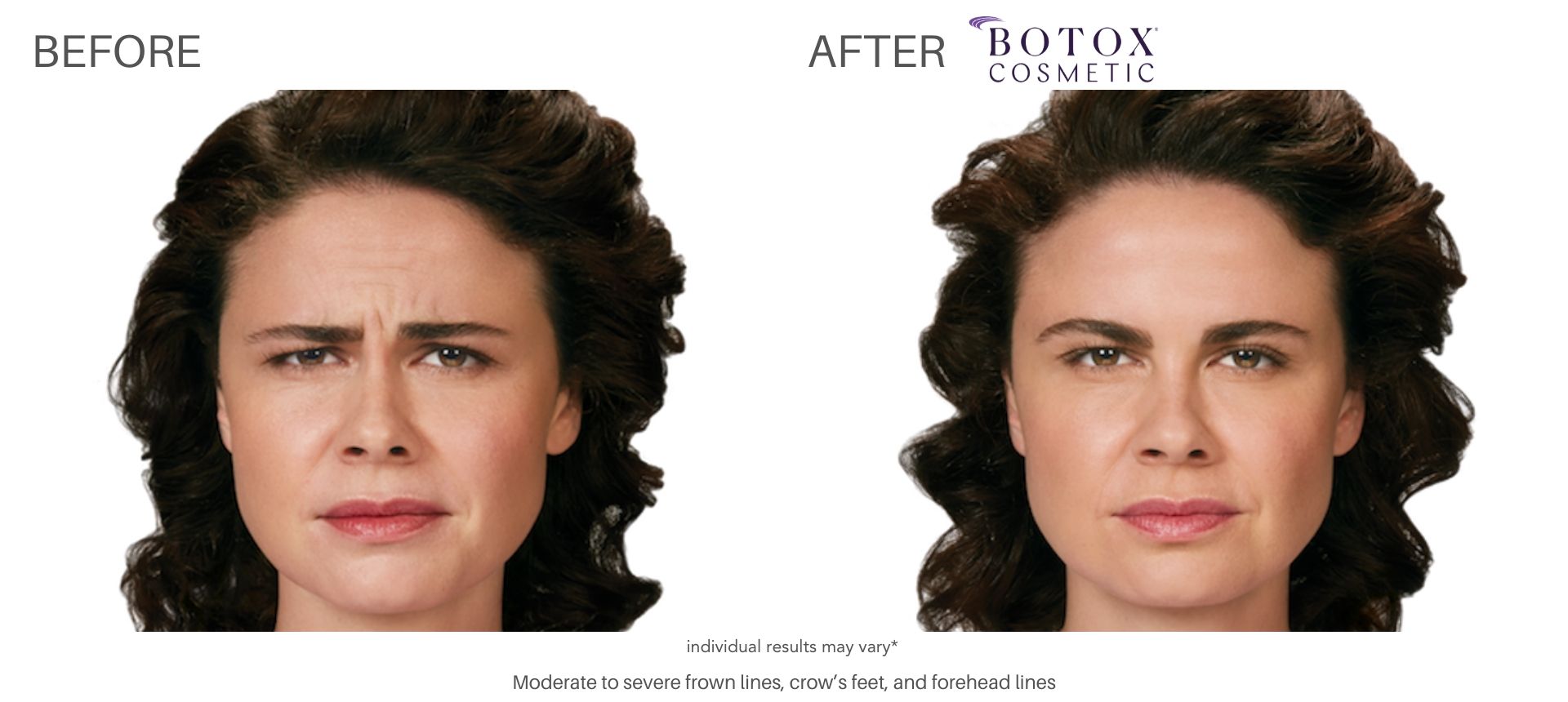 Woman's botox before and after results of forehead at Laser + Skin Institute.