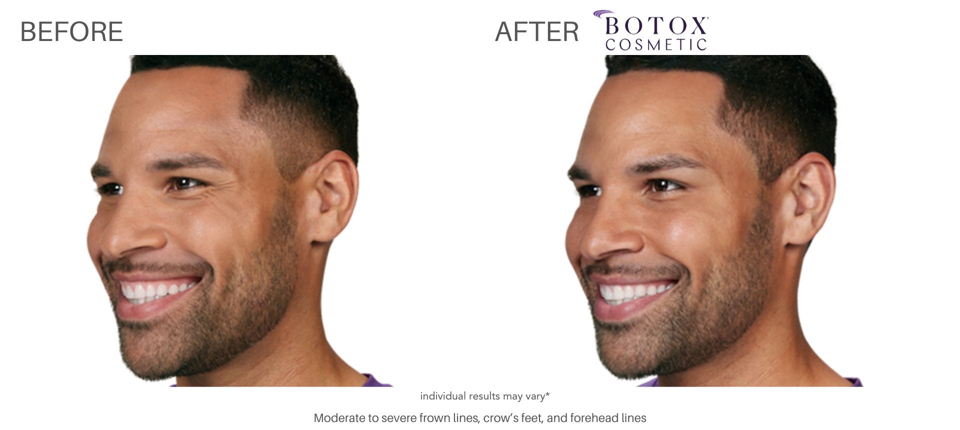 Man's botox before and after images of crows feet results at Laser + Skin Institute in Chatham, NJ.