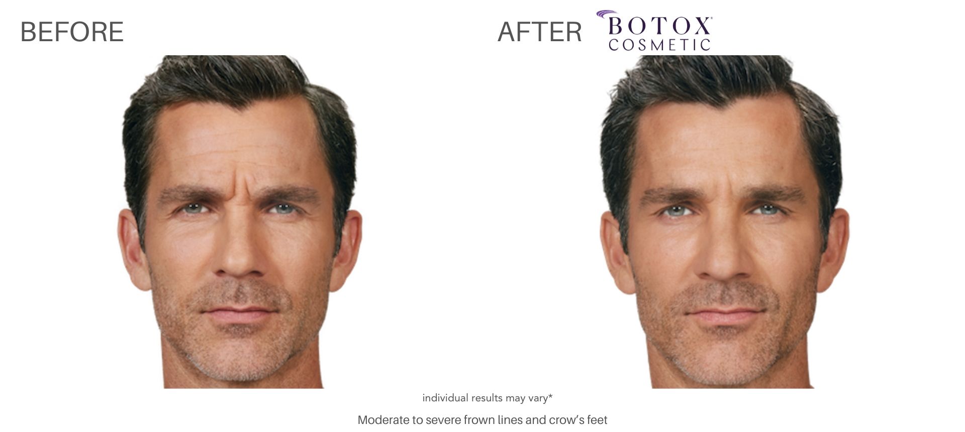 Man's botox cosmetics before and after treatment to forehead at Laser + Skin Institute in Chatham, NJ.