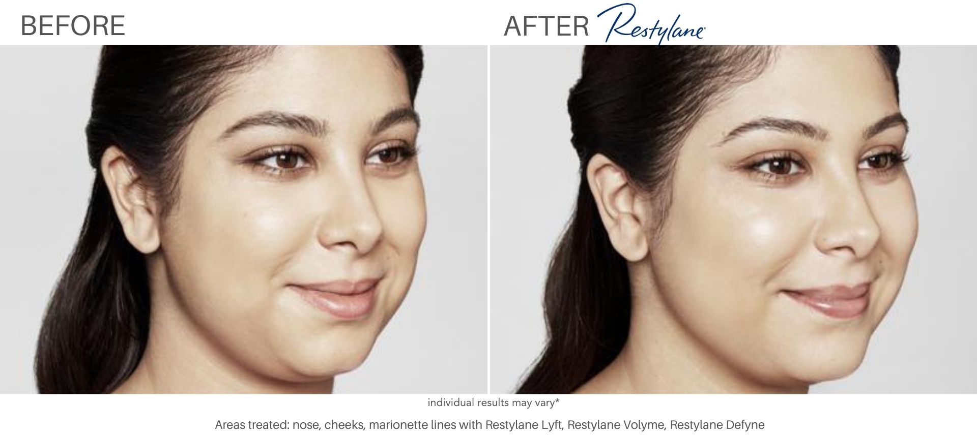 Woman's before and after results from Juvederm injections.