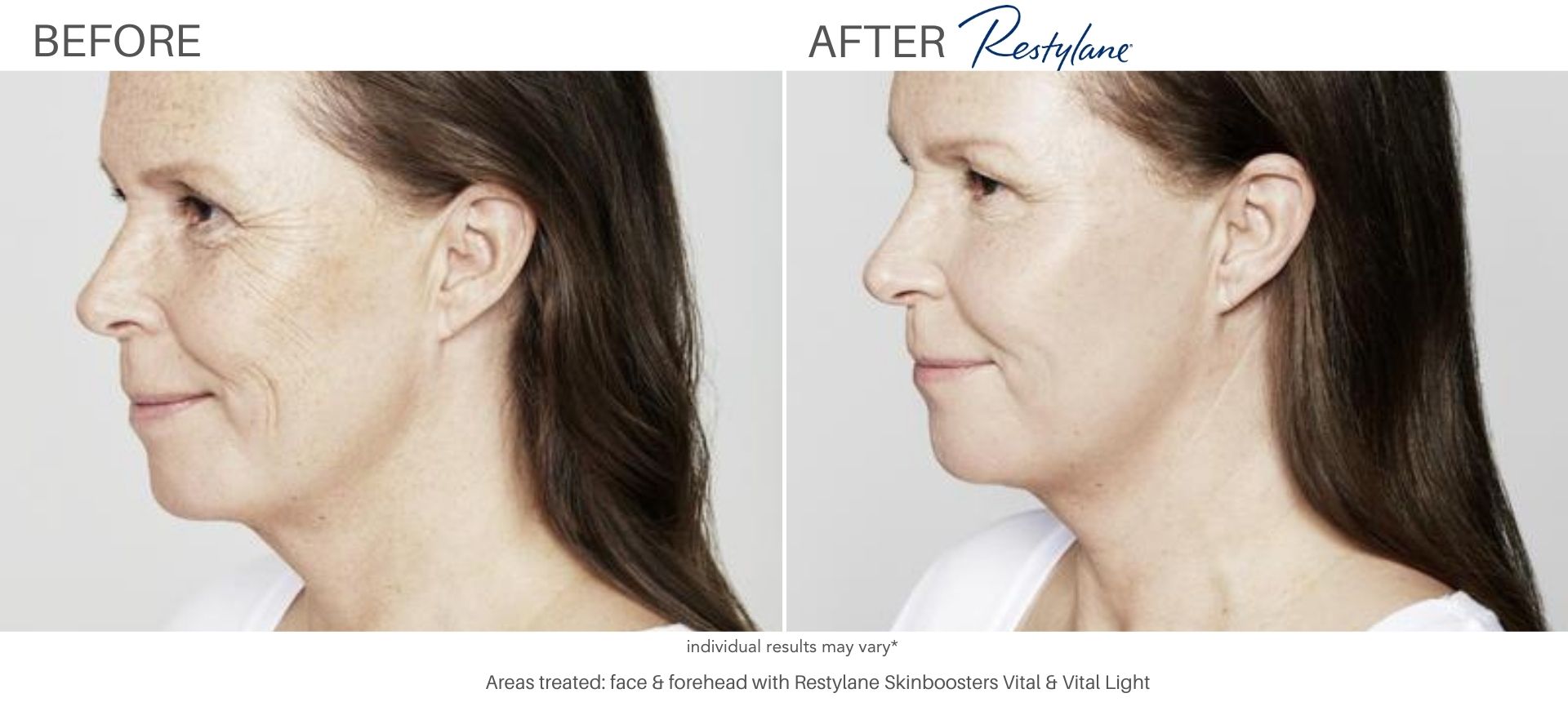 Woman's before and after results from Juvederm.