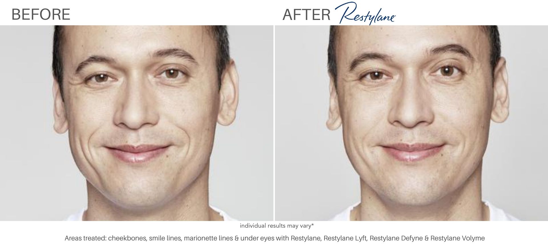 Man's before and after results from Juvederm.