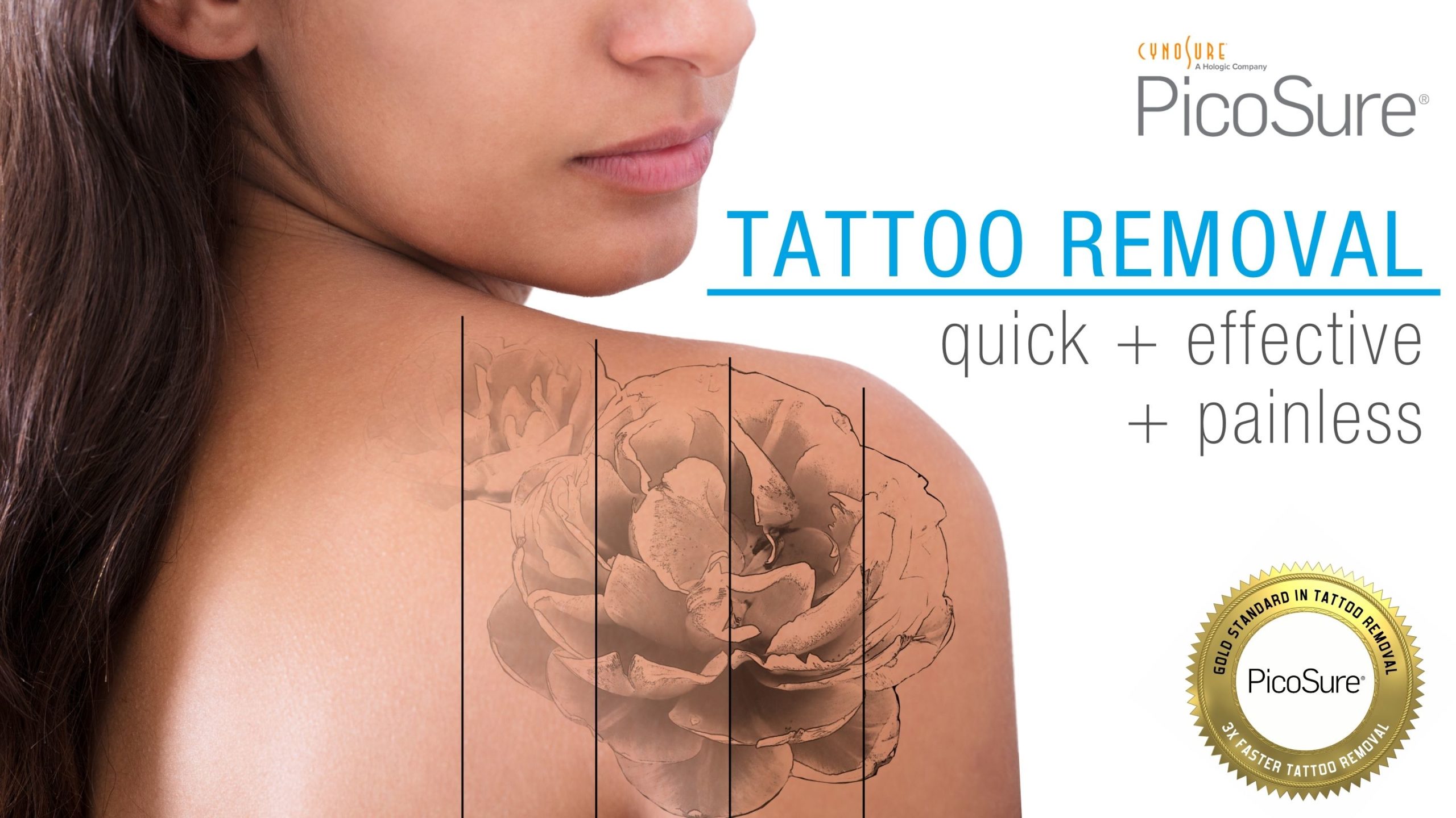 laser tattoo removal treatment on woman's back